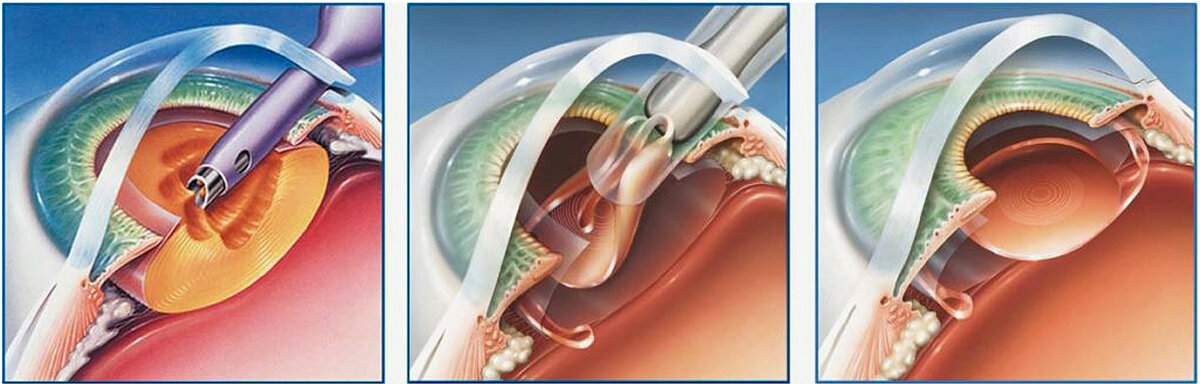 Этапы удаления катаракты (Яндекс картинки)