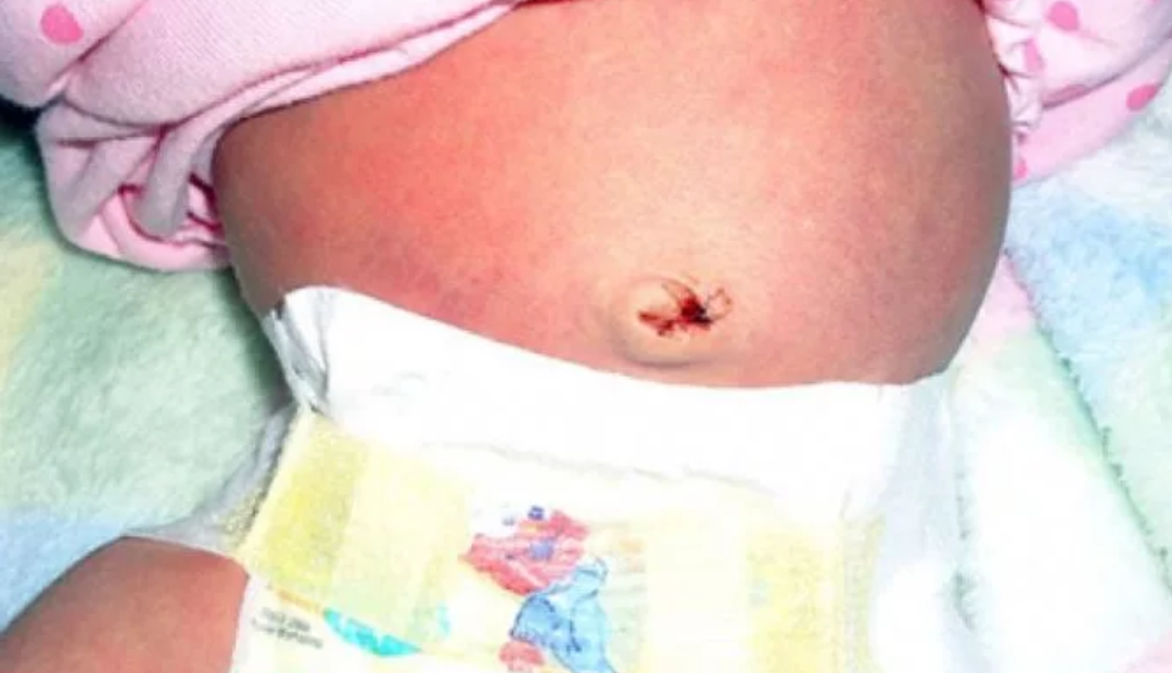 Небольшая кровоточивость пупка