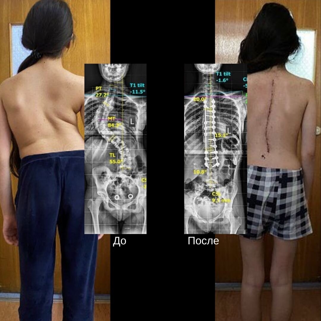 Сколиоз позвоночника у детей код. Институт сколиоза в Москве. Бабушка с сильным сколиозом. Видео людей у которых искривлен позвоночник.