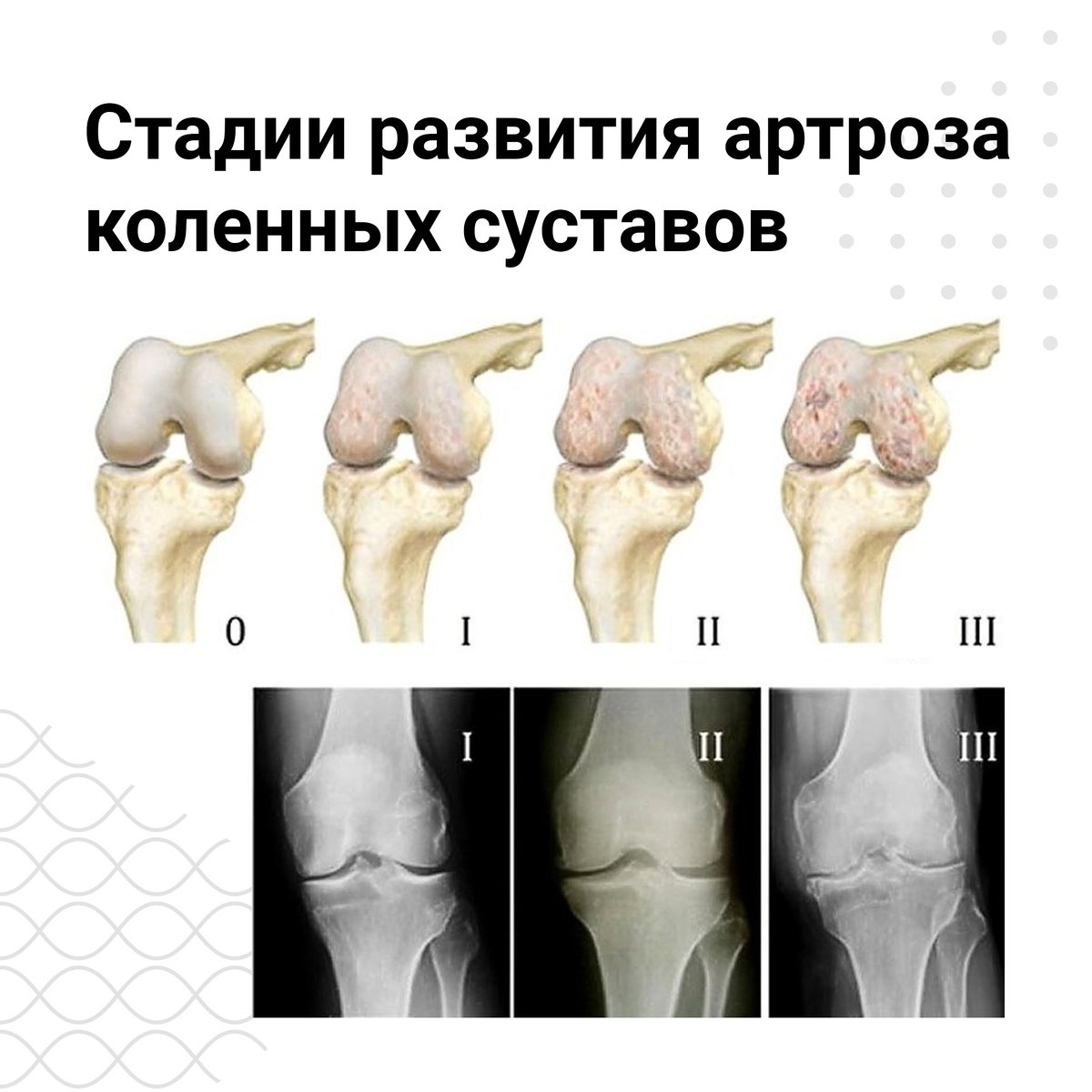 Остеоартроз 1 2 степени коленного сустава. Гонартроз коленного сустава 2. Деформирующий остеоартроз коленного сустава. Доа коленного сустава 2 степени.