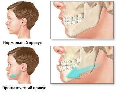 Фото до и после - ортодонтия, выравнивание зубов