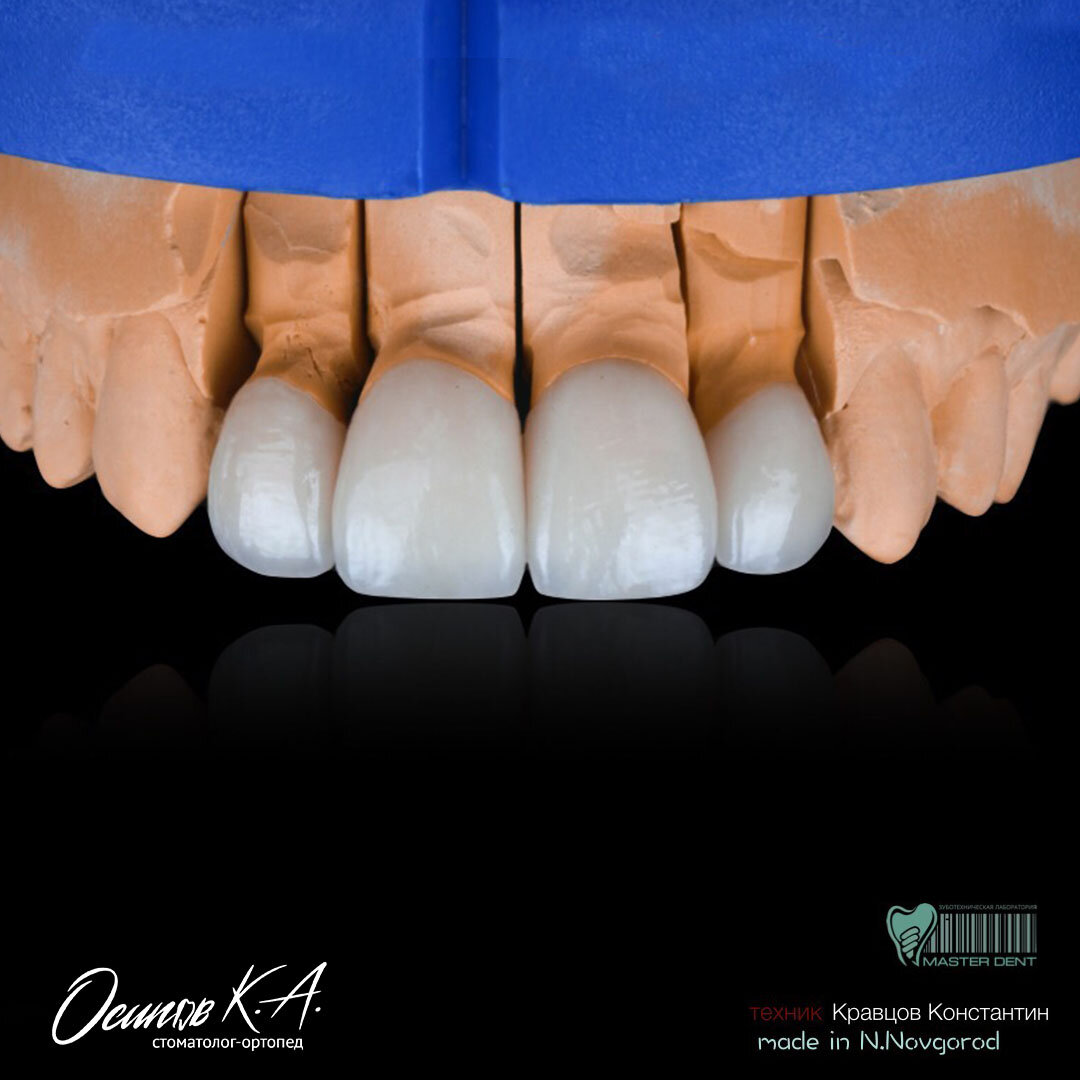 Фото 2. Коронки E-max.
