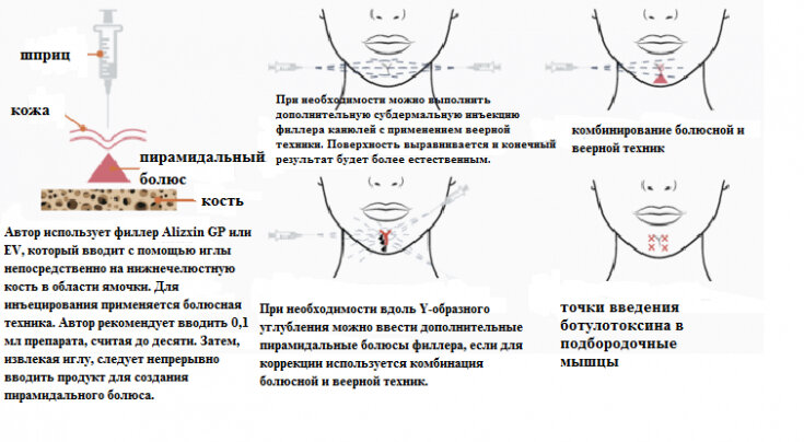 Техника введения филлера