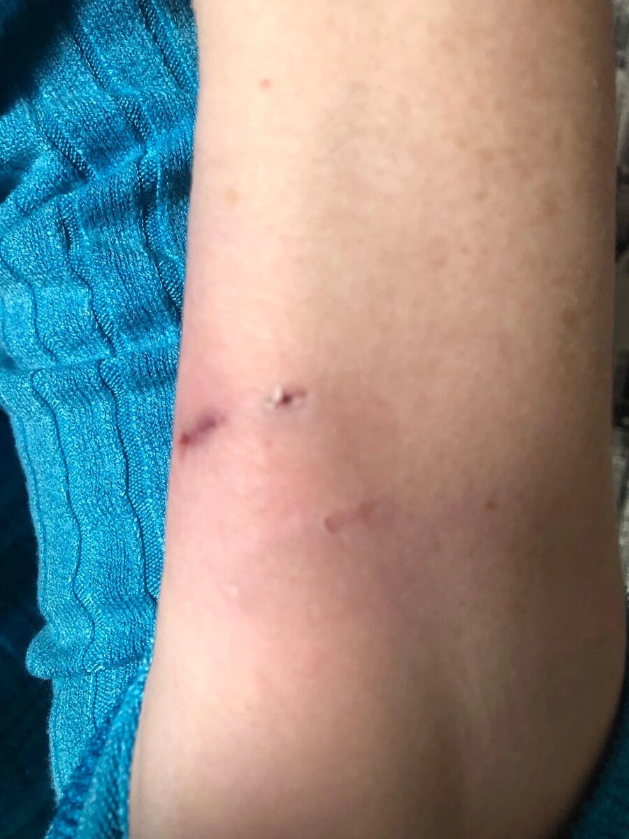 Это я пыталась снять бинт после взятия крови. 