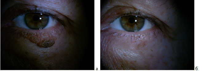 Пациентка К., 54 года, диагноз: врождённый невус н/века, до криолечения (а) и через 1,5 месяца после криохирургического лечения (б)