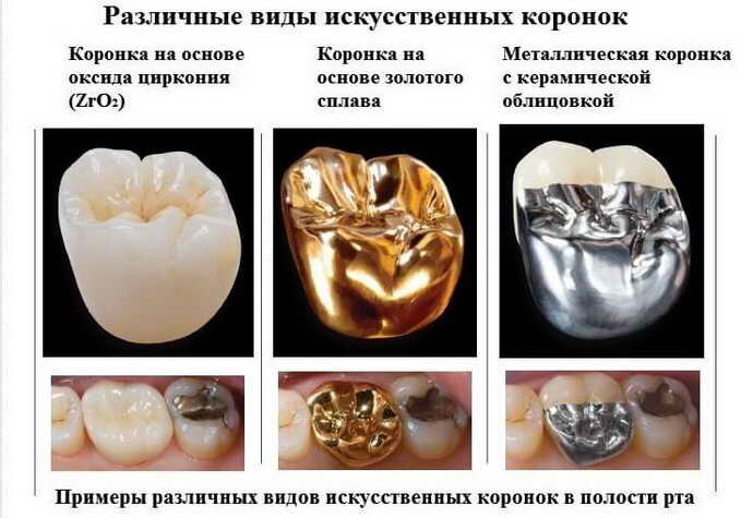 На какой зуб ставят коронку фото
