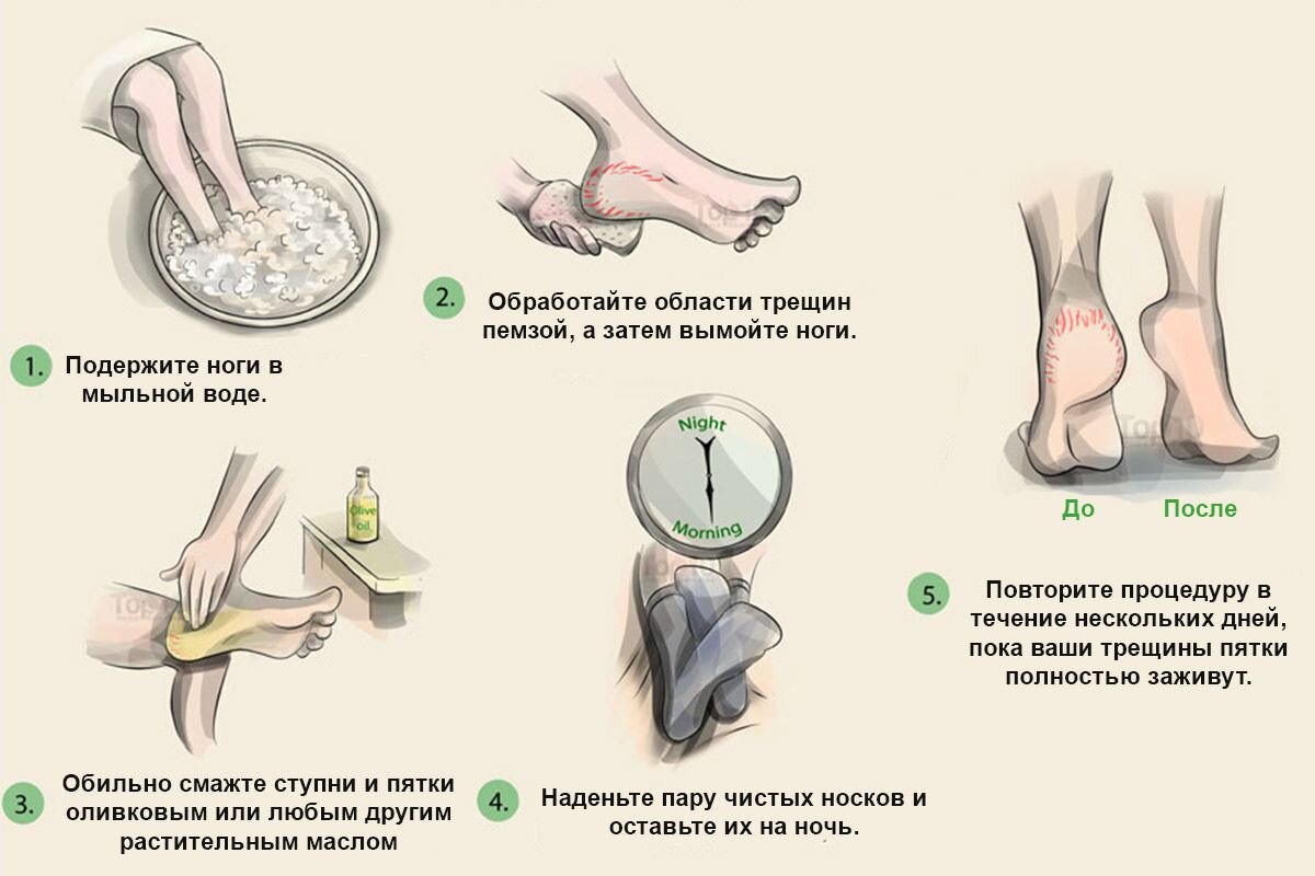 Эффективное средство от сухих пяток. | Jany Time | Дзен