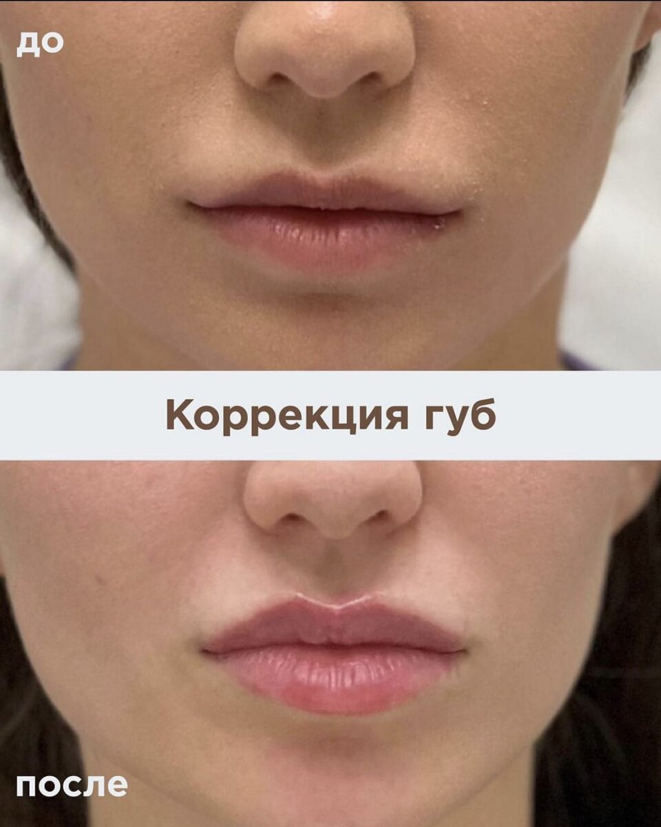 Контурная пластика губ до и после отзывы Ещё одна процедура контурной пластики губ.