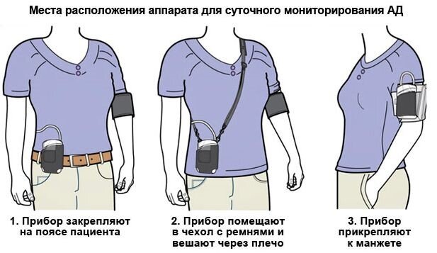 Прибор для измерения давления закрепить на теле ещё проще, чем прибор для мониторинга сердечного ритма