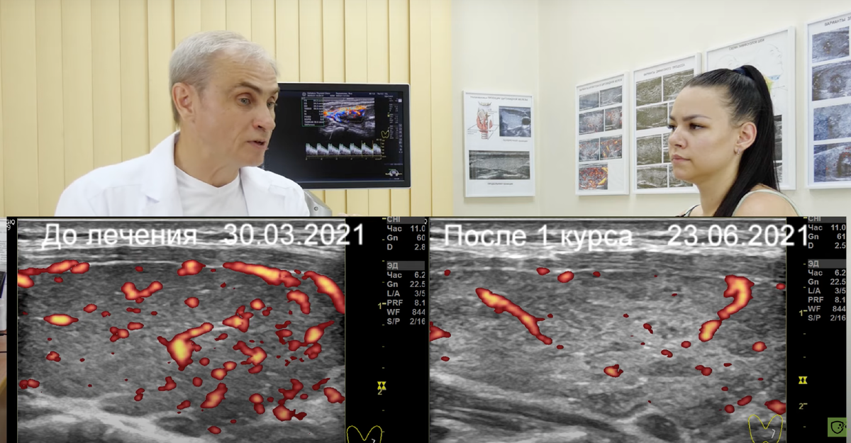 Доктор Ушаков рассказывает в фильме и показывает результаты восстановления щитовидной железы после 1-го курса лечения