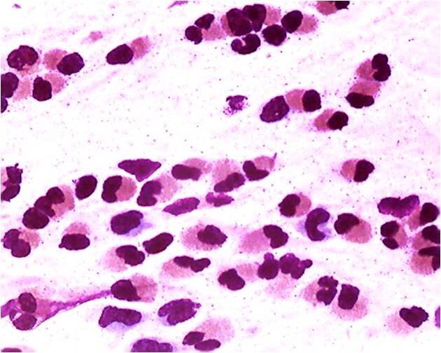 Назоцитограмма. Аллергический ринит. Большое количество эозинофилов. Окраска по Папенгейму. х1000
