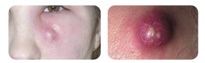 СРОЧНО К СТОМАТОЛОГУ! Фурункул на лице.