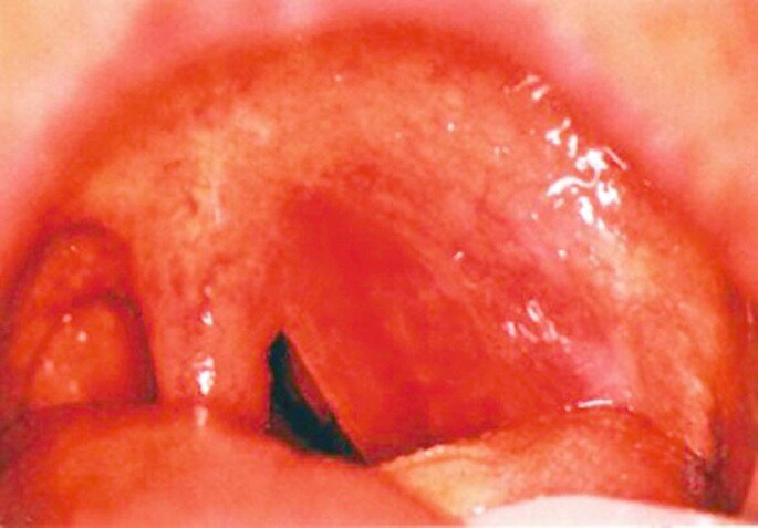 перитонзиллярный абсцесс