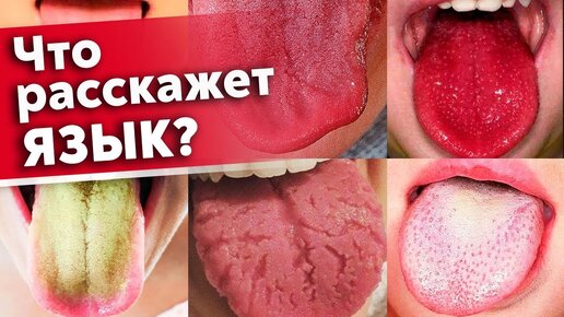 Язык предупредит вас о болезнях! Как диагностировать состояние организма по языку?