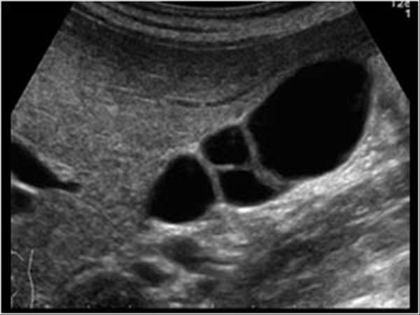 При водянке желчного пузыря в эхографической картине обычно не отмечается