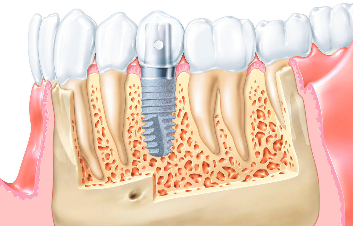 Восстановление костной ткани зубов. Костная пластика (остеопластика). Костная ткань при имплантации зубов. Костная пластика в стоматологии.