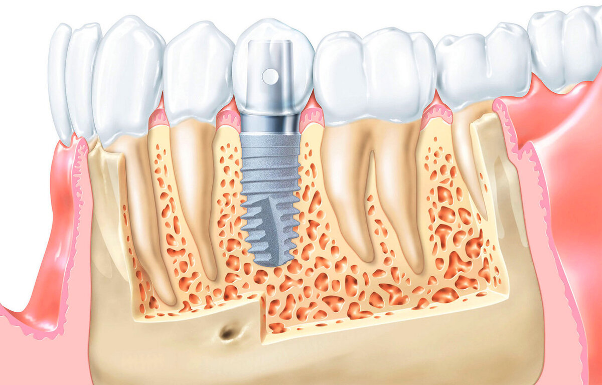 Как приживается зубной имплант