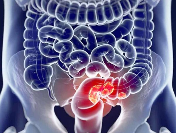 Ai grijă de intestinul tău!  Oncologul a spus cum să minimizeze riscul de a dezvolta cancer colorectal.