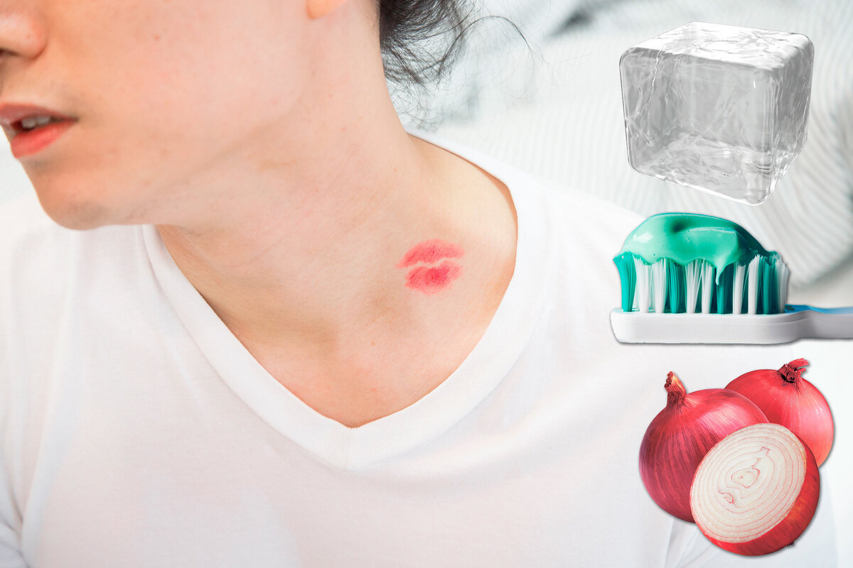     След амура: как быстро убрать засос в домашних условиях