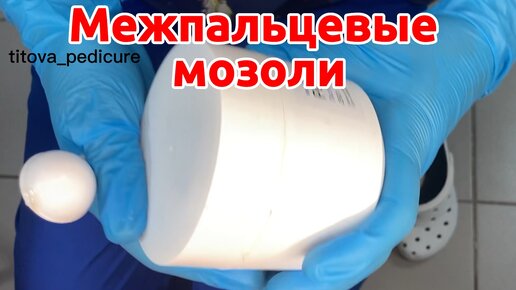 Межпальцевая мозоль/боль между пальцами #мозоли#удаление мозоли#ортезы# ...