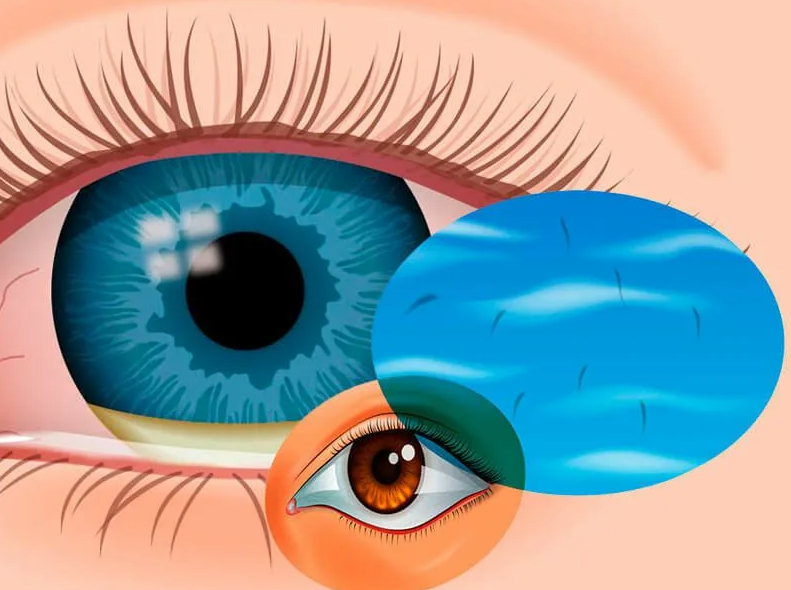 чёрные мушки перед глазами. мушка перед. деструкция стекловидного тела мушки. мушка перед. мушка перед.