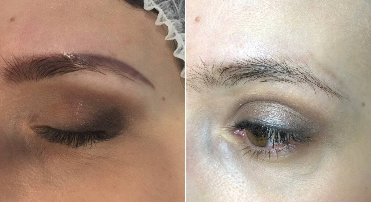 До и После лазерного удаления татуажа бровей