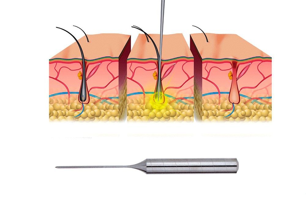 Электроэпиляция картинки. Волосяной фолликул. Электроэпиляция схема.