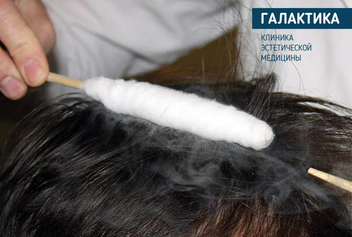 Криомассаж волосистой части головы. Криотерапия для кожи головы. Криомассаж волос жидким азотом.