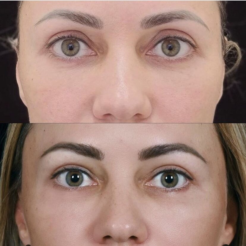 устранение А деформации липофилингом