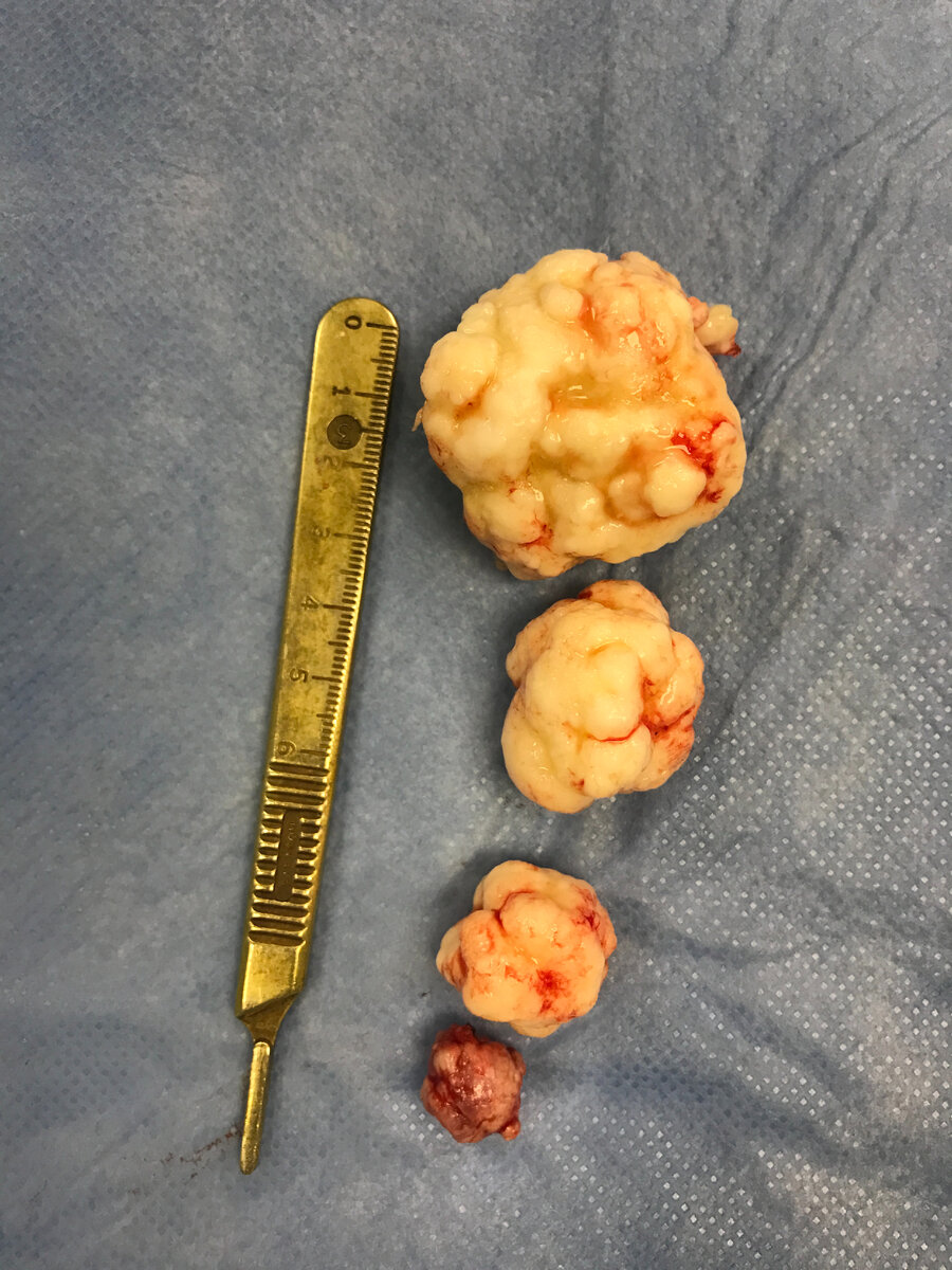 При выполнении операции эндопротезирование коленного сустава извлекли 4 хондромных тела