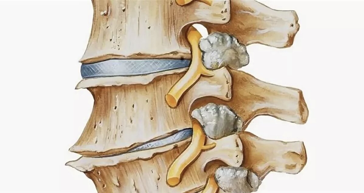Деформирующий спондилез - лечение, симптомы, причины, диагностика | Центр Дикуля