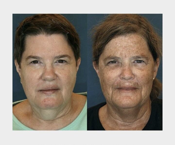 Пример преждевременного старения кожи.