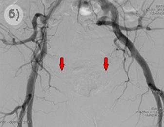 Эмболизация простаты. Эмболизация простатических артерий. Эмболизация артерий предстательной железы. Эмболизация артерий предстательной железы. Эмболизация аденомы предстательной железы.