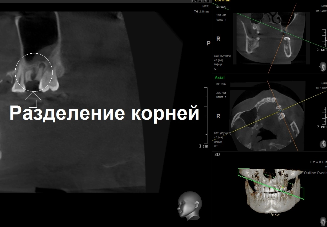 Клкт амикорт. Конусно лучевая томография. Расшифровка снимок КЛКТ. КЛКТ 1200.