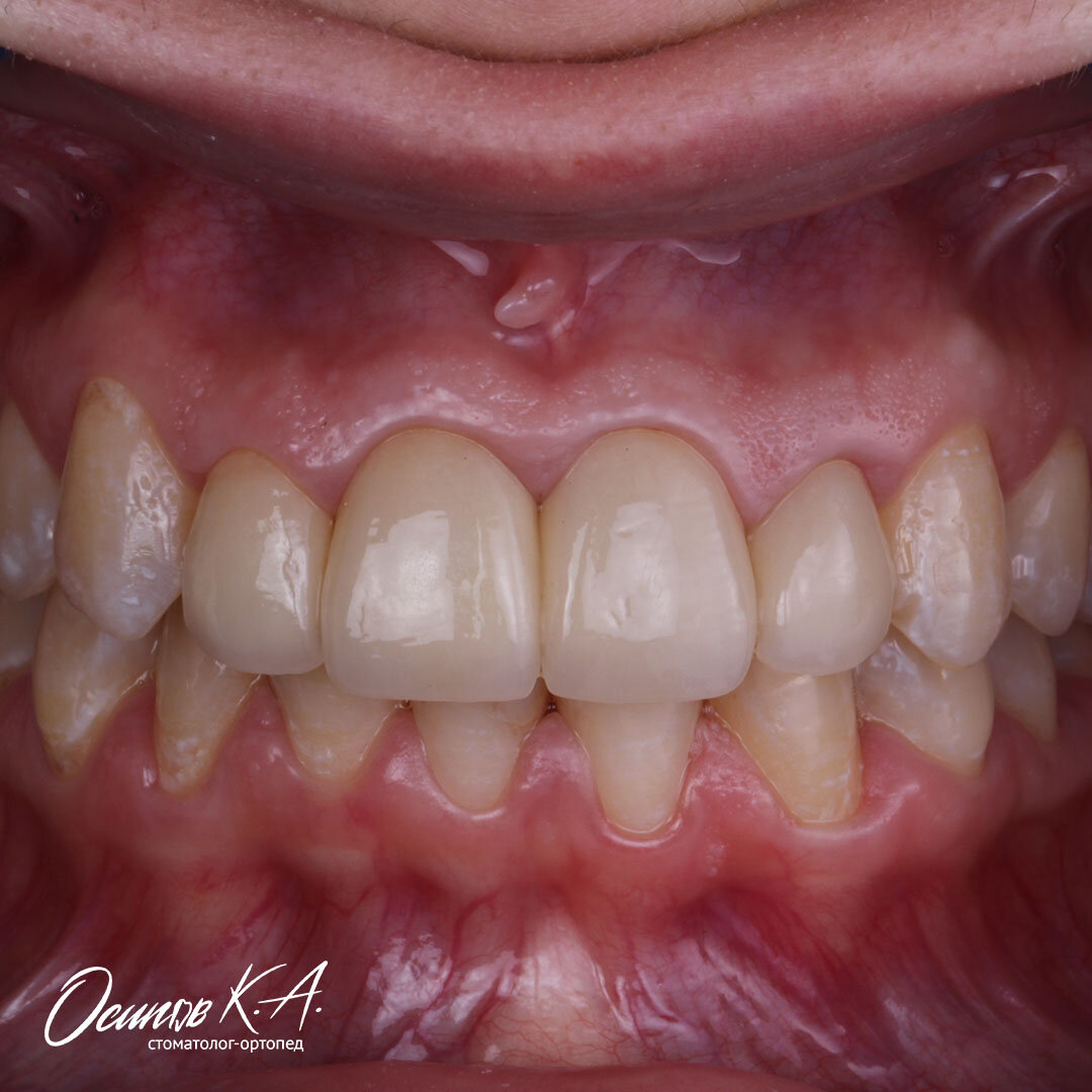 Фото 1. Результат лечения
