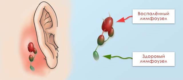 Лимфаденит — воспаление лимфоузлов