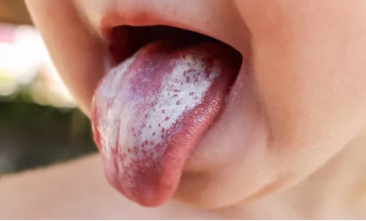 Кандидозный глоссит