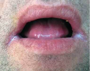 Кандидозная заеда