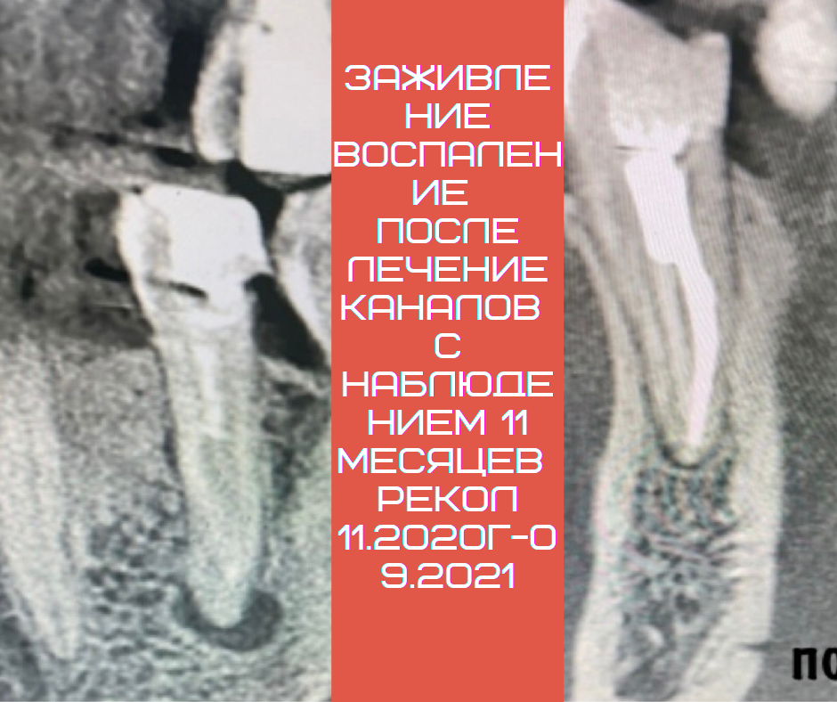 Заживление воспаление после лечение корневых каналов с наблюдением 11 месяцев с 11.2020г по 09.2021г ‼️

Клиническая ситуация : ”Лечение корневых каналов 35 -го зуба и по максимуму его сохранение ‼️”
Листайте карусель 👉

Жалобы были: -на боли 35 зуба -на разрушение 35 зуба -на разрушение 35 зуба -на застревание пищи  -на боли при надкусывание
-на сильные разрушеннуи
-на сохранение 35 зуба-на подготовка зубов под протезирование 😎👏🙏‼️👍✅

Было бы приятно :- Консультация , осмотр , -фото протокол, - диагностика 3D рентген , -планы -согласование планов лечение -совместные консультации-лечение корневых каналов-лечение прикуса - протезирование и эстетика ✊🤗🤩😎👏

Поэтапно планировали лечение , провели консультацию и рентген диагностику 3D, согласовали планы , проели чистку и вот теперь будет лечение корневых каналов. Далее будет санация полости рта , удаляется зубы мудрости, лечение прикуса и протезирование🙃👌👏🤩🤗

По времени заняло 2 часа , по 3 посещение с интервалом недели . Материалы : Ah+, гуттаперчи 02 конусность, размер 20, эстелайт а2.✅

@prodoctorov.ru @pd.club 
——————————————————
Ваш заботливый доктор Dr. Zaripov .
Мой телефон ☎️ 89190128262 или по ☎️ 8(492)277-99-33 в клинике @laviani-clinic
Наш адрес: г. Владимир, ул. Добросельская 176, здание Бэбибум, 2 этаж
#фото #фотопротокол #фотосьемка 
#напоминаниедляпациентов
#интервью #отбеливаниезубов #zoom4 
#обменопыта
#амбассадорпд2021
#профилактика 