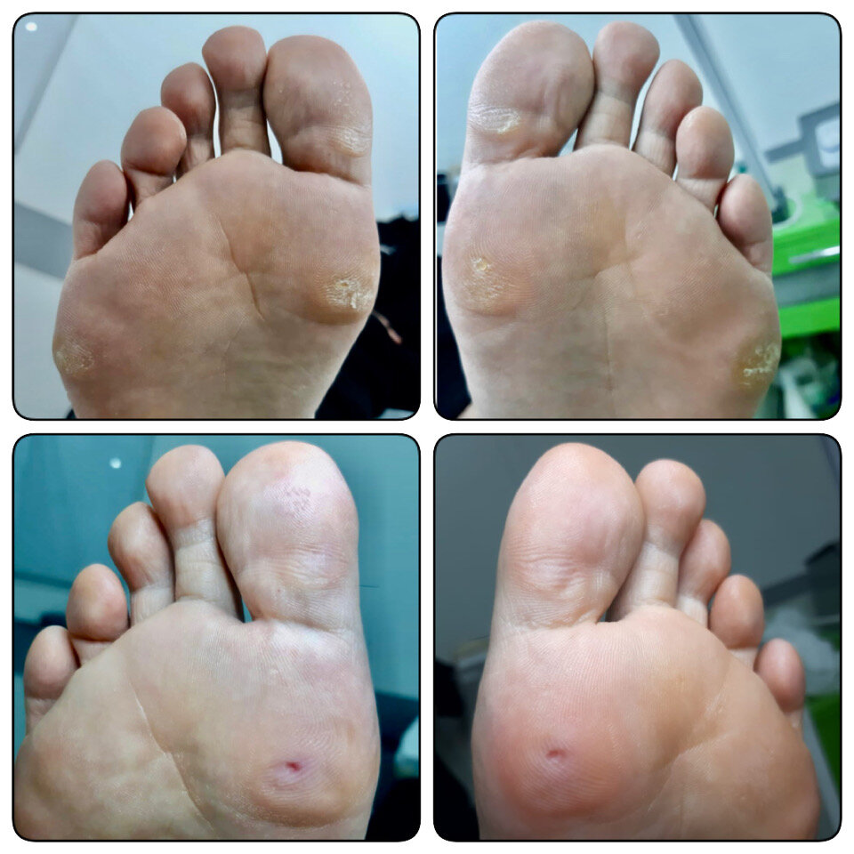 Стержневой мозоль