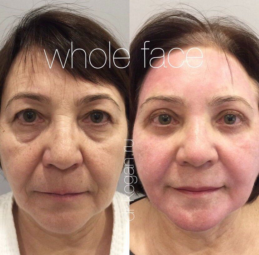 Блефаропластика верхних и нижних век с фракционным лазерным омоложением СО2. Фото до и после. Фото предоставлено врачом дерматологом косметологом клиники Д.Р. Гришкяна - Коган Л.С. Имеются противопоказания, требуется консультация специалиста