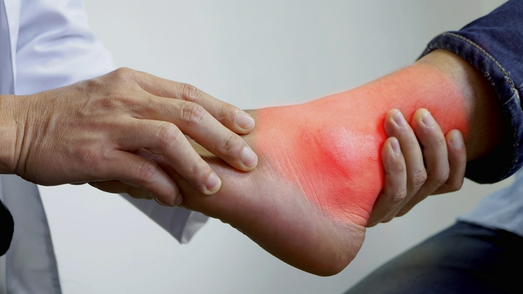 Тофус - очаг ненормального уплотнения подкожной жировой клетчатки