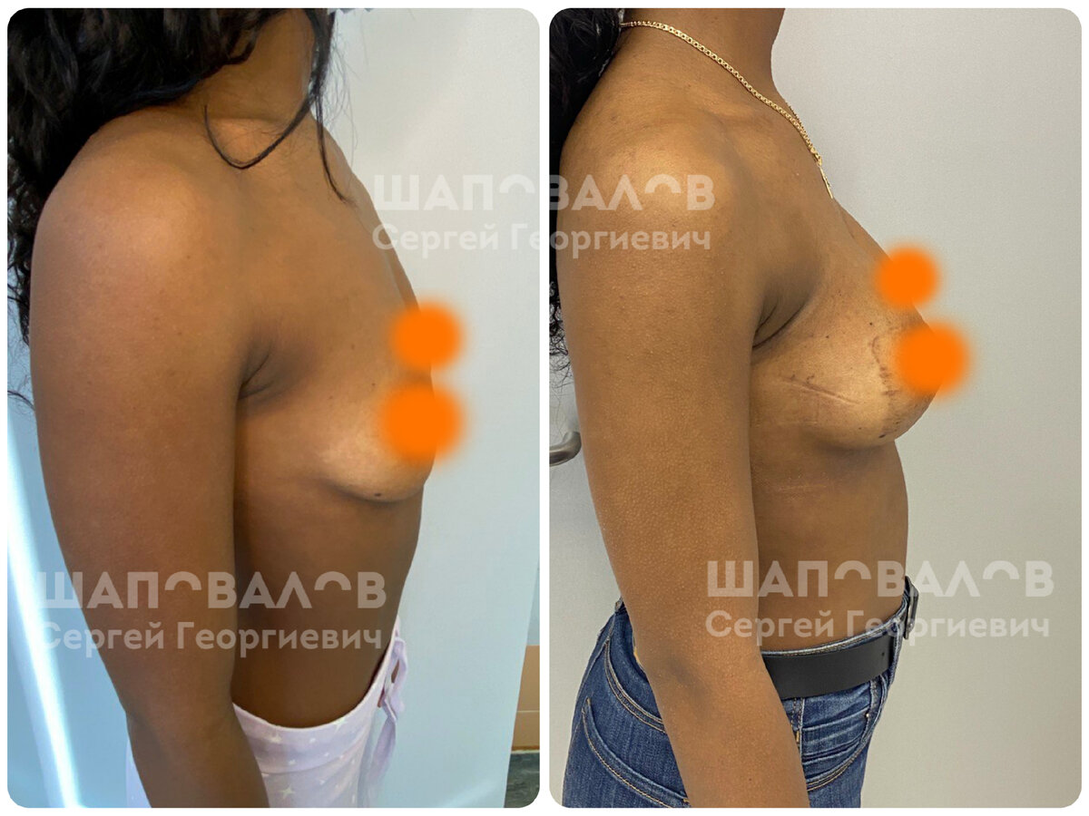 операция на груди у женщин фото 73
