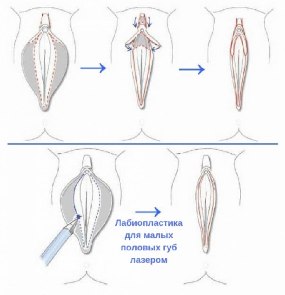 Гипертрофия половых губ | Центр Дикуля