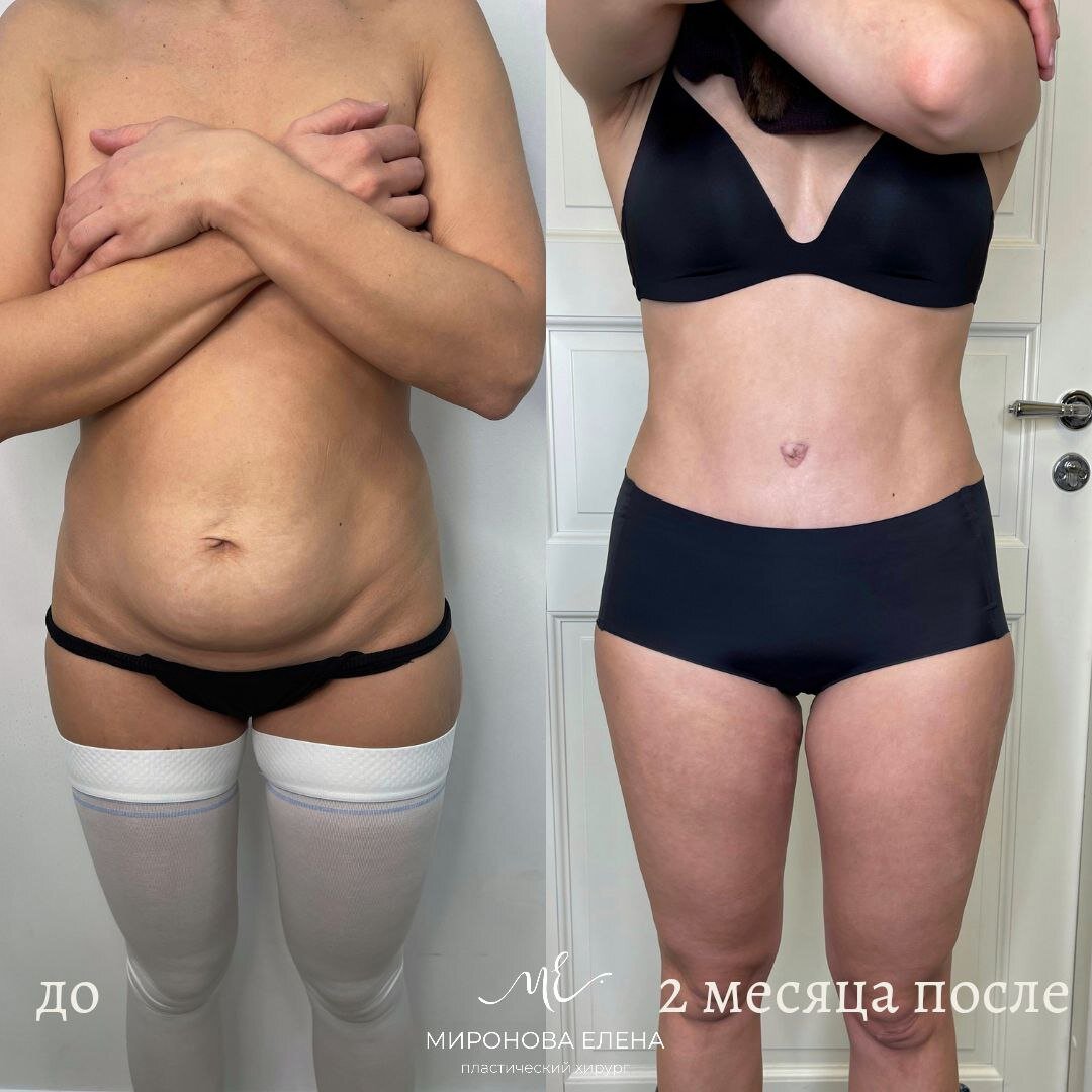 Пациентка Мироновой Е.А. после абдоминопластики с пластикой пупка, ушиванием диастаза прямых мышц, посакции живота и спины.