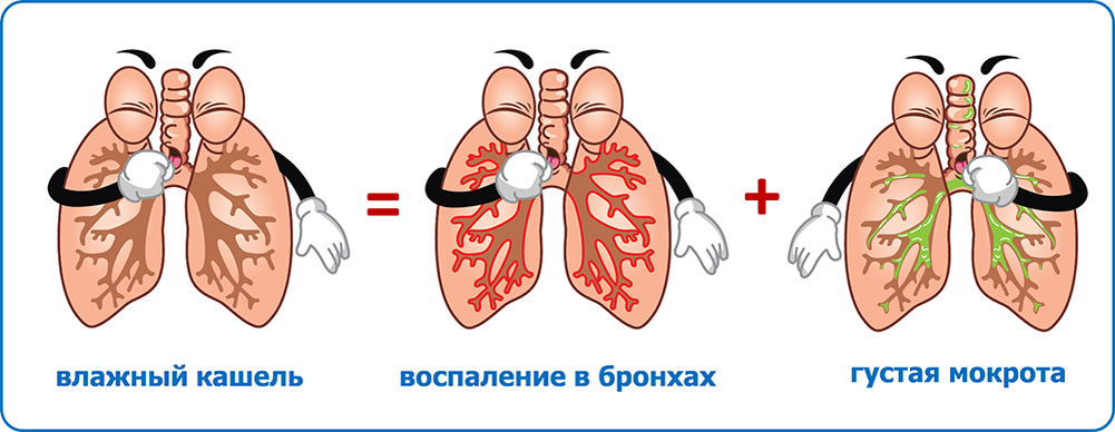 Кашель с мокротой. Влажный кашель.