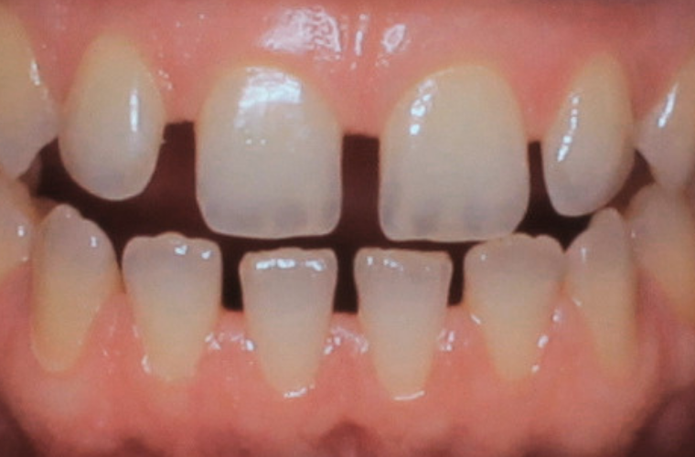 Эти три эти бугорка на поверхности зуба называются мамелонами и являются абсолютной нормой