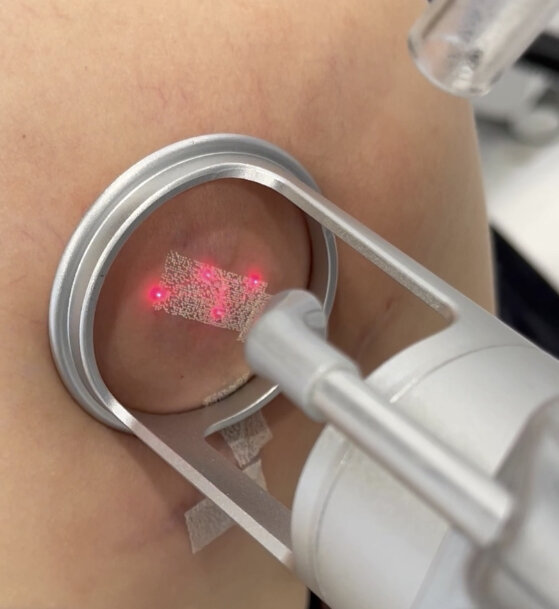 Процесс шлифовки шрама с помощью CO2 лазера в клинике Sokolov.Laser 
