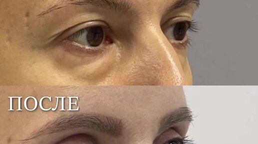 Клиника \"Время Красоты\" | ⚡️Блефаропластика в клинике «Время Красоты ...