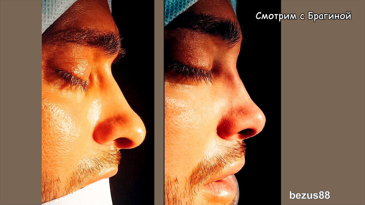 Новый курносый нос Безуса, инстаграм
